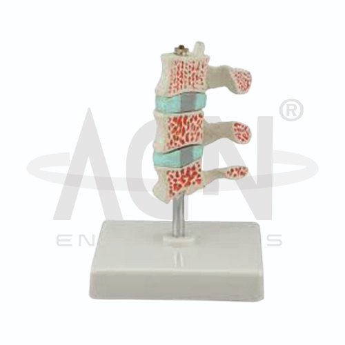 Advanced Osteoporosis Model
