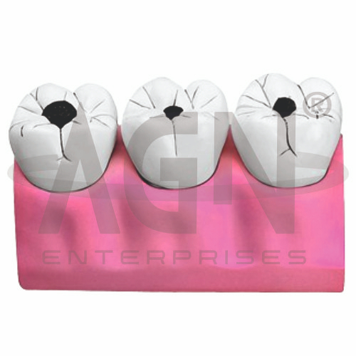 Dental Caries Model