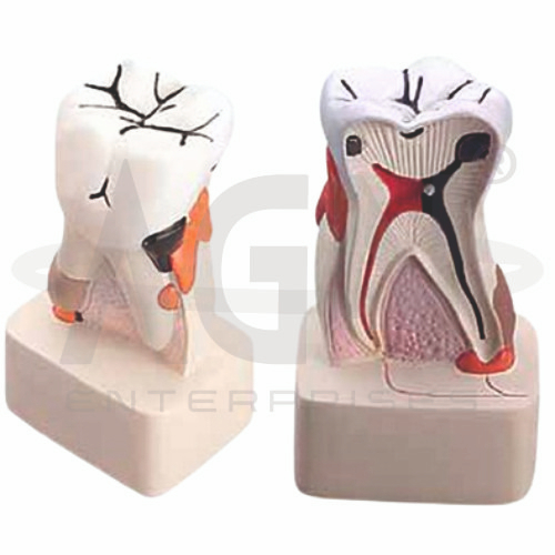 Dental Pathology Model