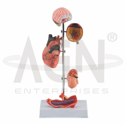 Effects Of Hypertension
