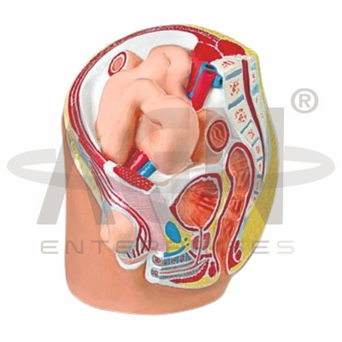 Indirect Inguinal Hernia