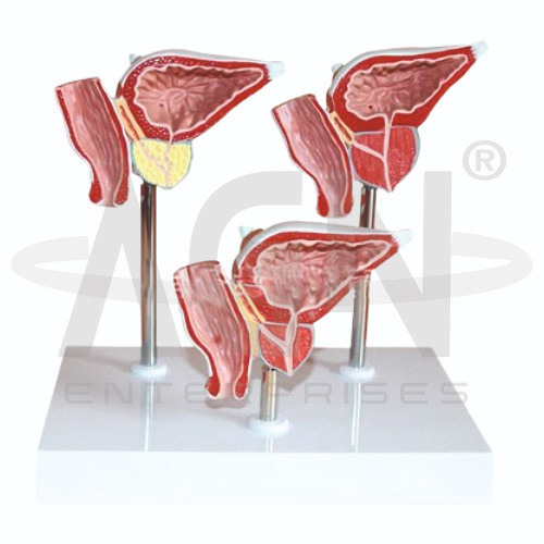 Normal & Diseased Prostate Gland