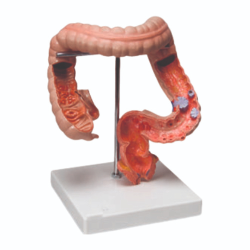 Pathological Model Of Colon And Rectum