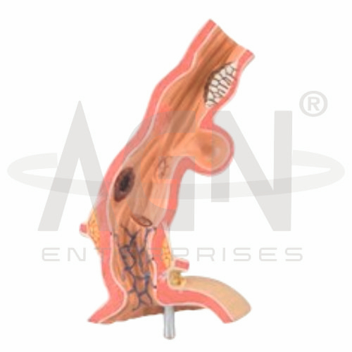 Pathological Model Of Esophagus