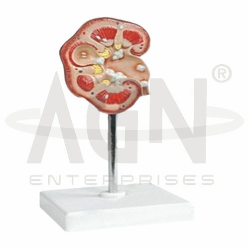 Pathological Model Of Renal Calculus