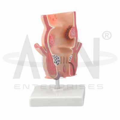 Pathological Model Of The Rectum